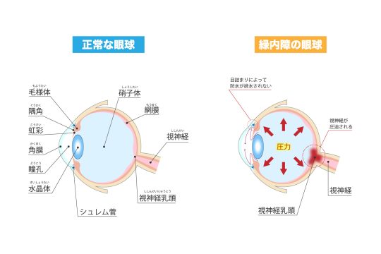 緑内障